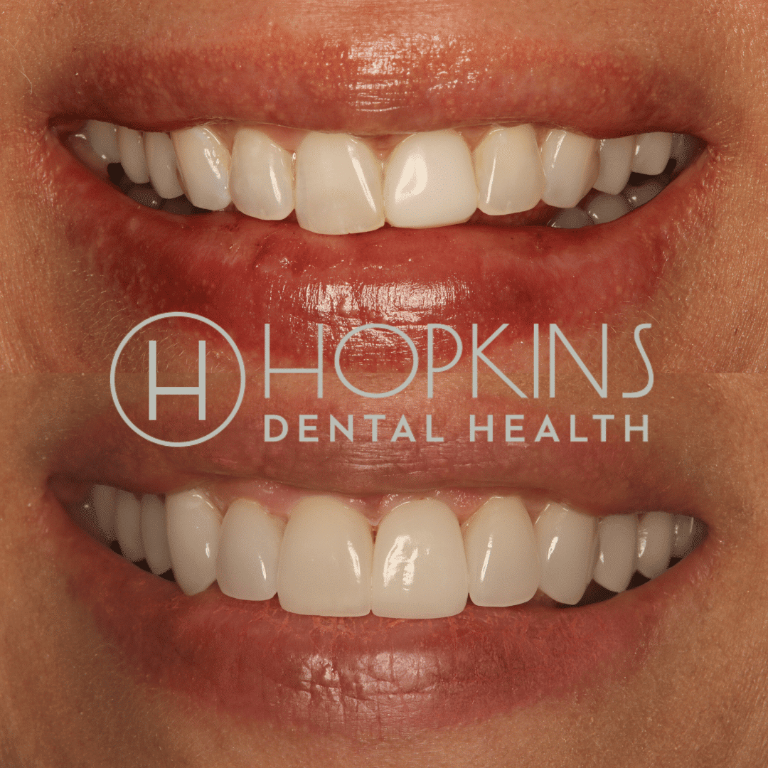 Smile Designs Hopkins Dental Health