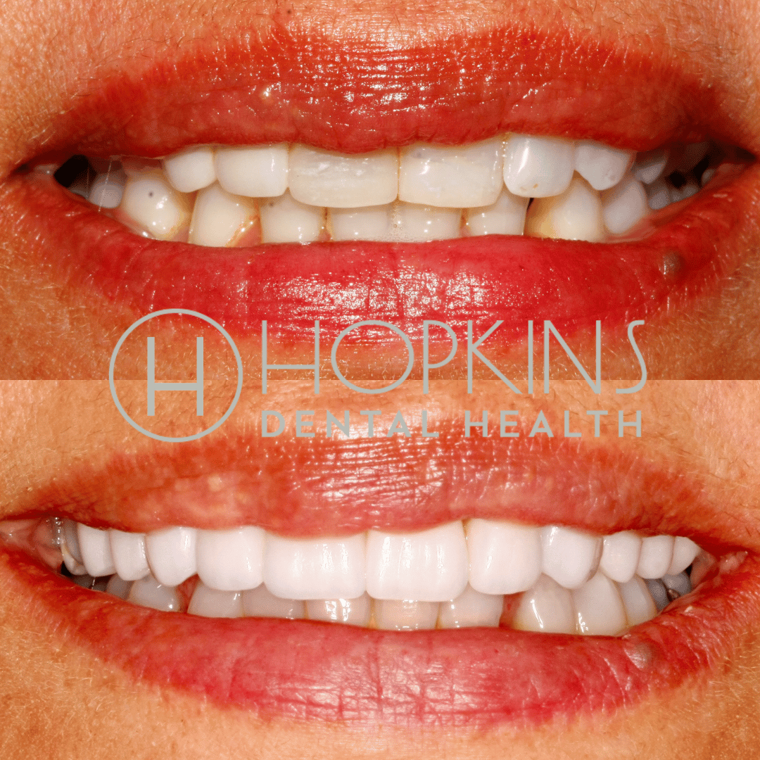 Smile Designs Hopkins Dental Health
