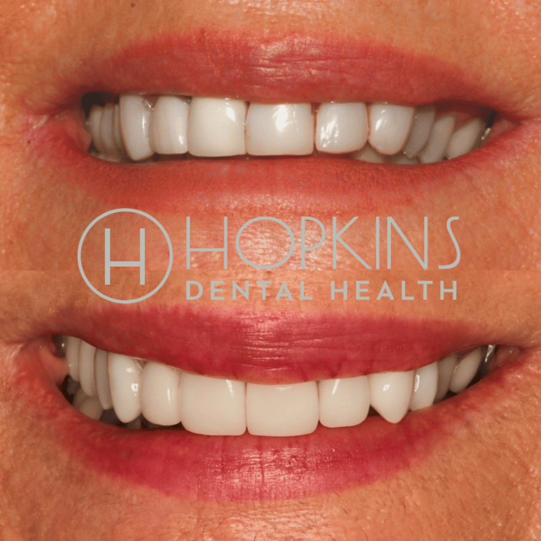 Smile Designs Hopkins Dental Health