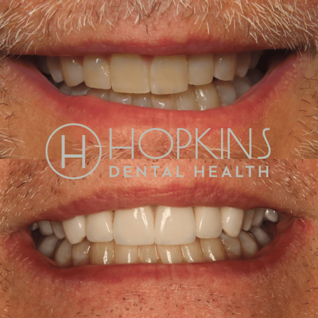 Smile Designs Hopkins Dental Health