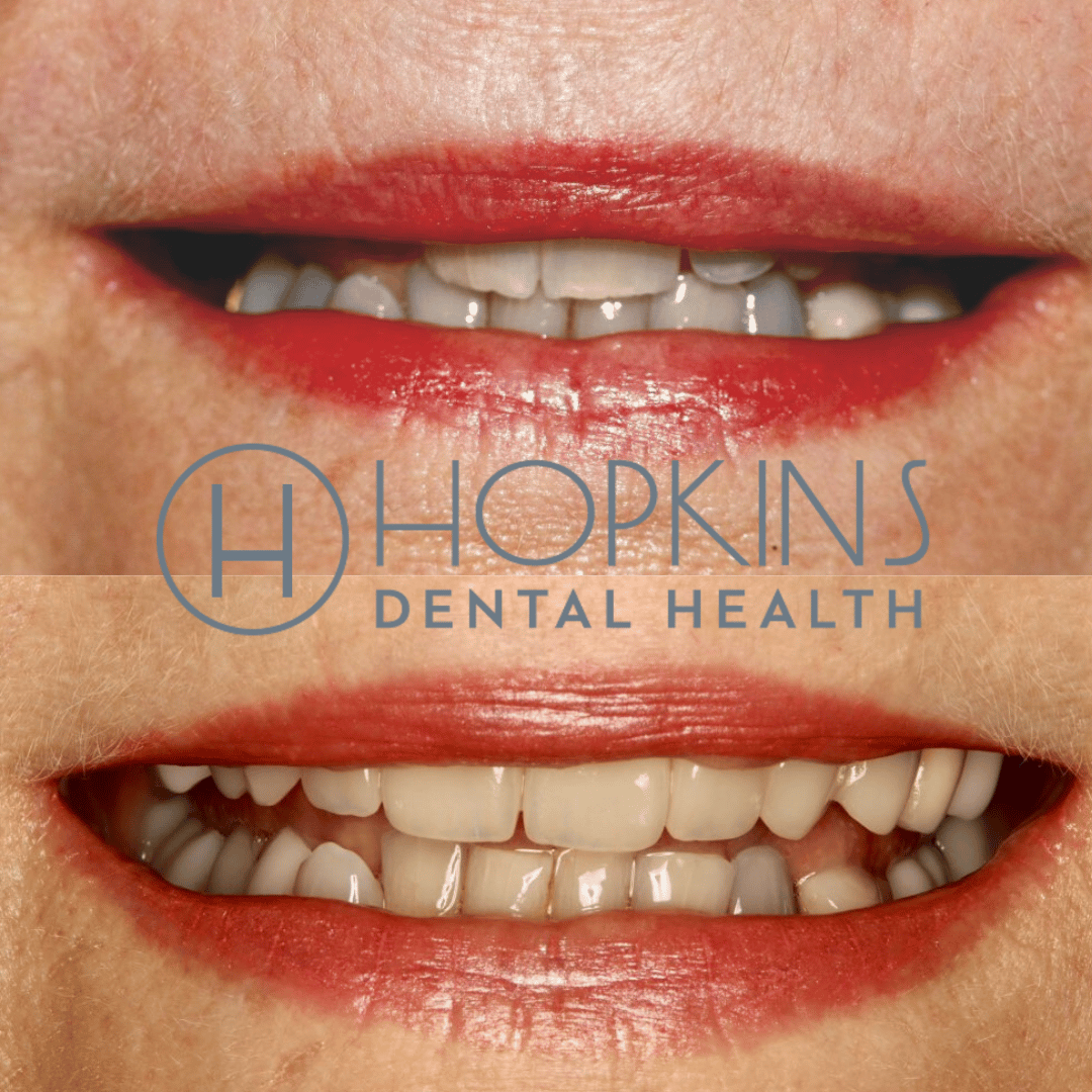 Smile Designs Hopkins Dental Health